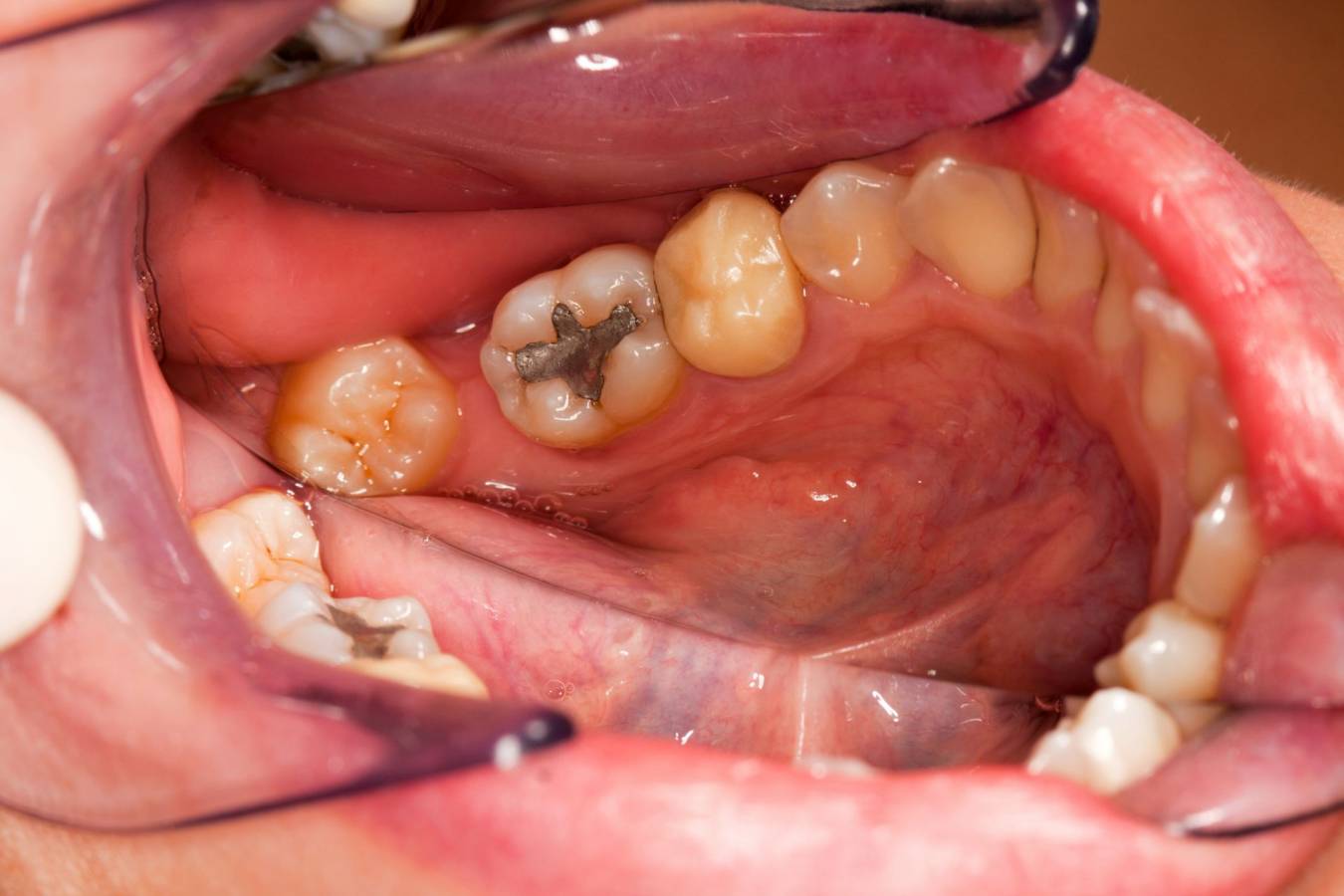 » Amalgam VS Composite Fillings – The Controversy