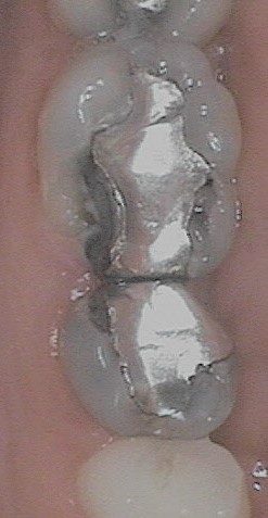 broken-amalgam-1