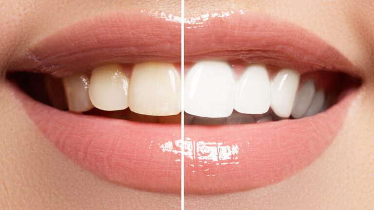 Side-by-side model of a teeth after a whitening procedure compared to before the procedure